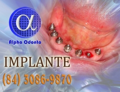 Implante dentÁrio inferior total - (84) 3086-9870